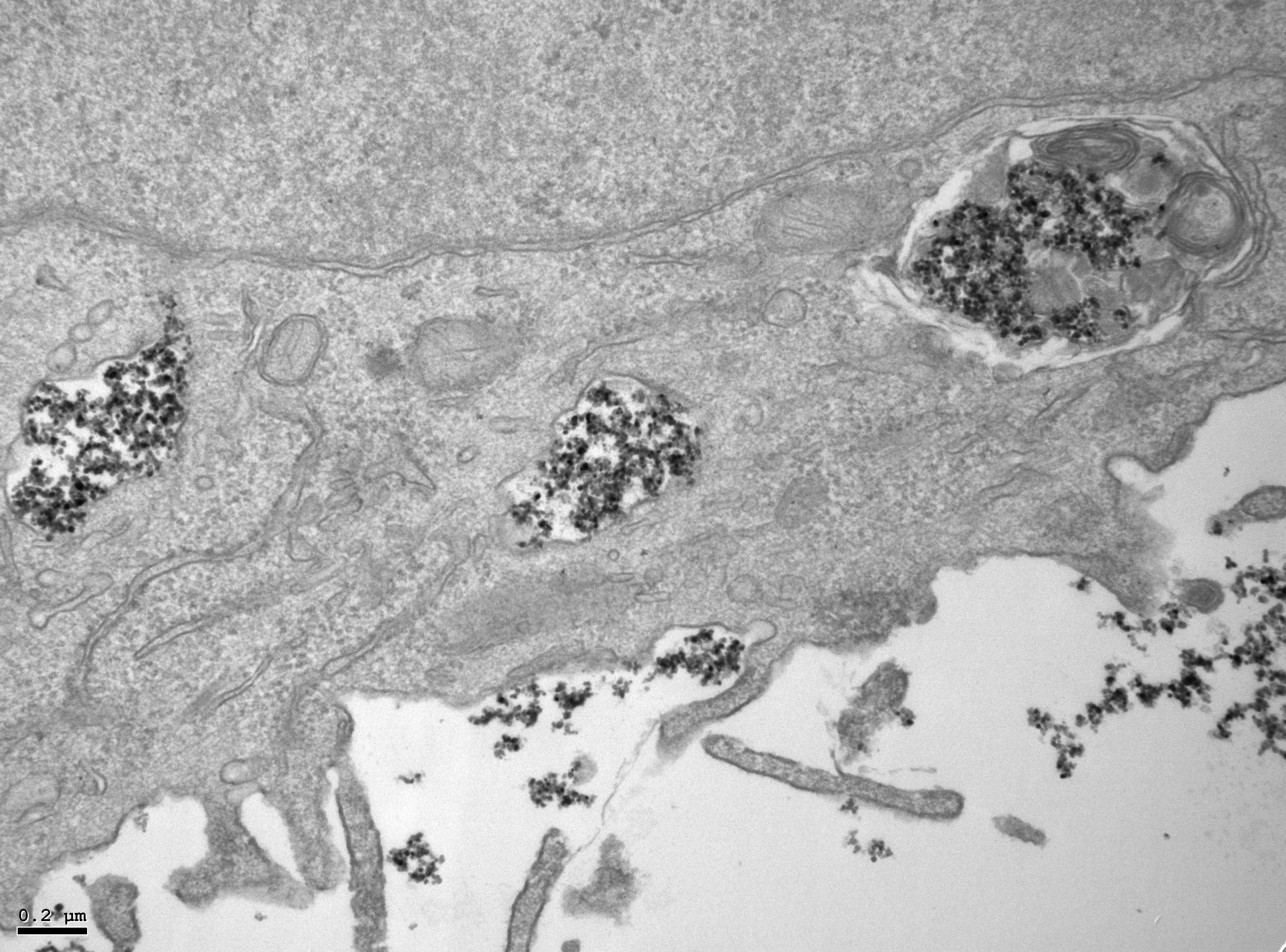 Celulas tumorales cargadas de nanoparticulas