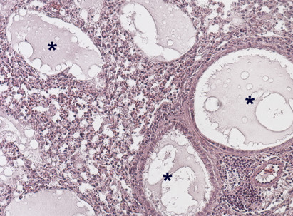 Edema pulmonar