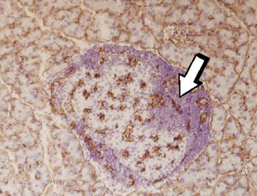 Islote pancreático