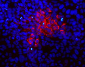Infección por el virus de la hepatitis C