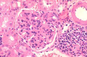 Imagen representativa de la patología renal en ratones modelo de lupus